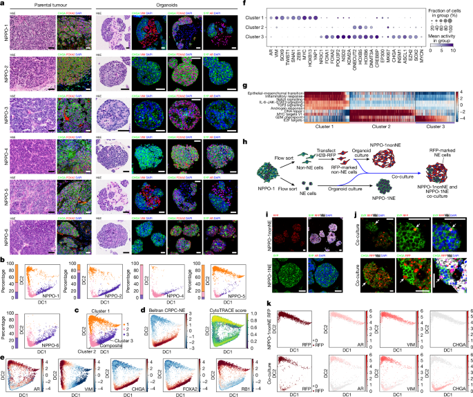 NSD2 targeting reverses plasticity and drug resistance in prostate cancer